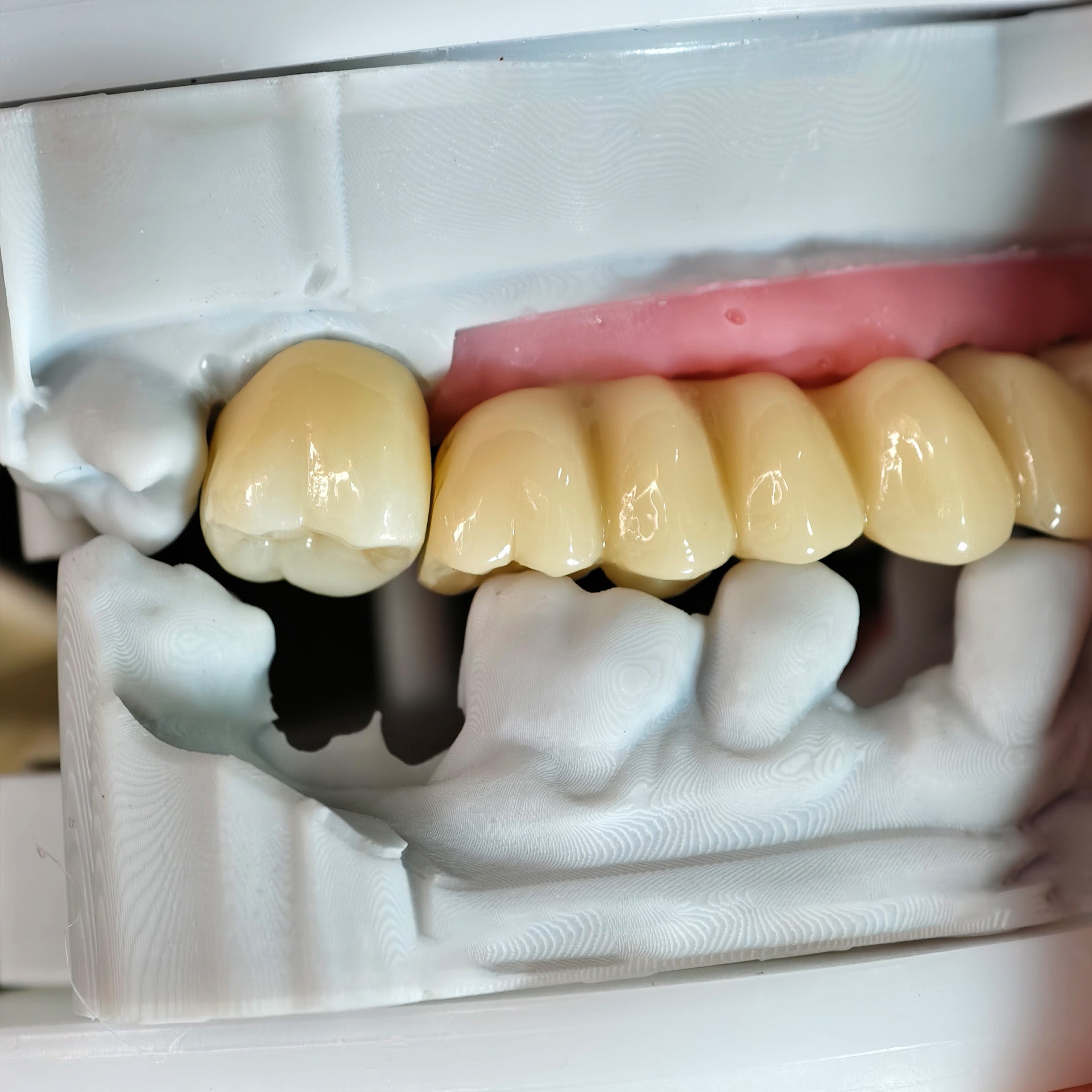 Zirconia Implant Bridge Screwmentable Dental Crown