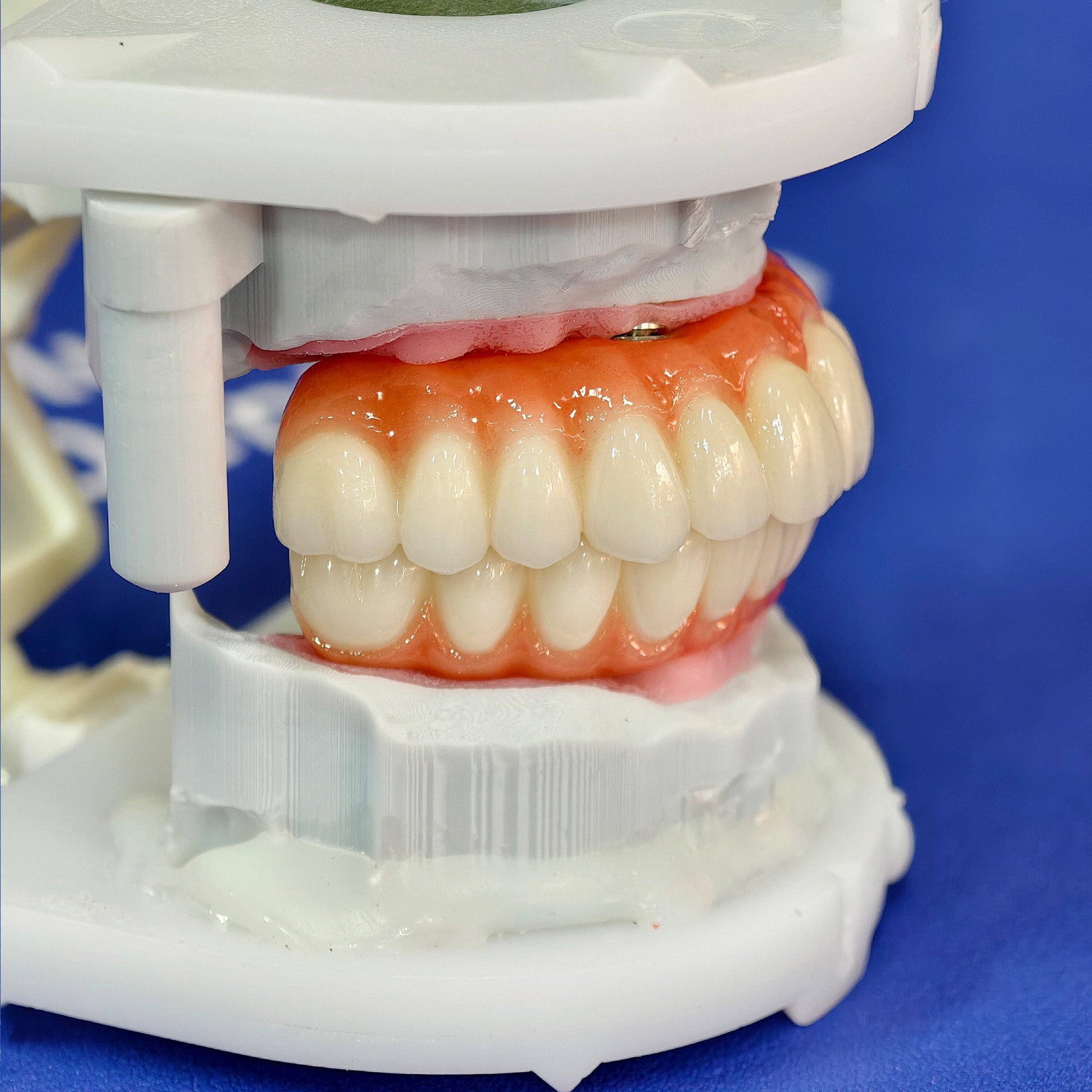 All On 4 Zirconia Bridge With Ti-Base Screw Retained Trying For Full Arch Restoration