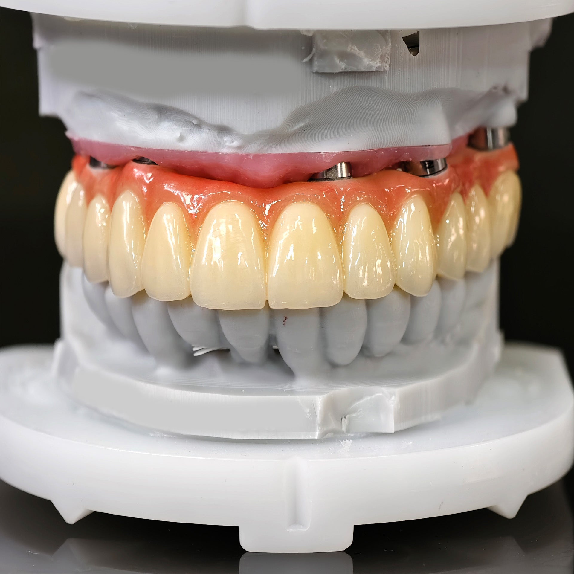 All On 5 Zirconia Bridge With Ti-Base Screw Retained Trying For Full Arch Restoration