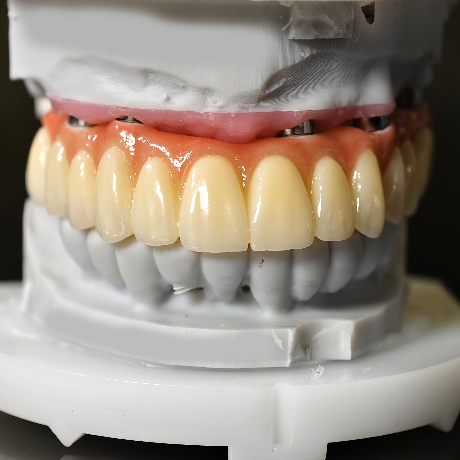 All On 5 Zirconia Bridge With Ti-Base Screw Retained Trying For Full Arch Restoration
