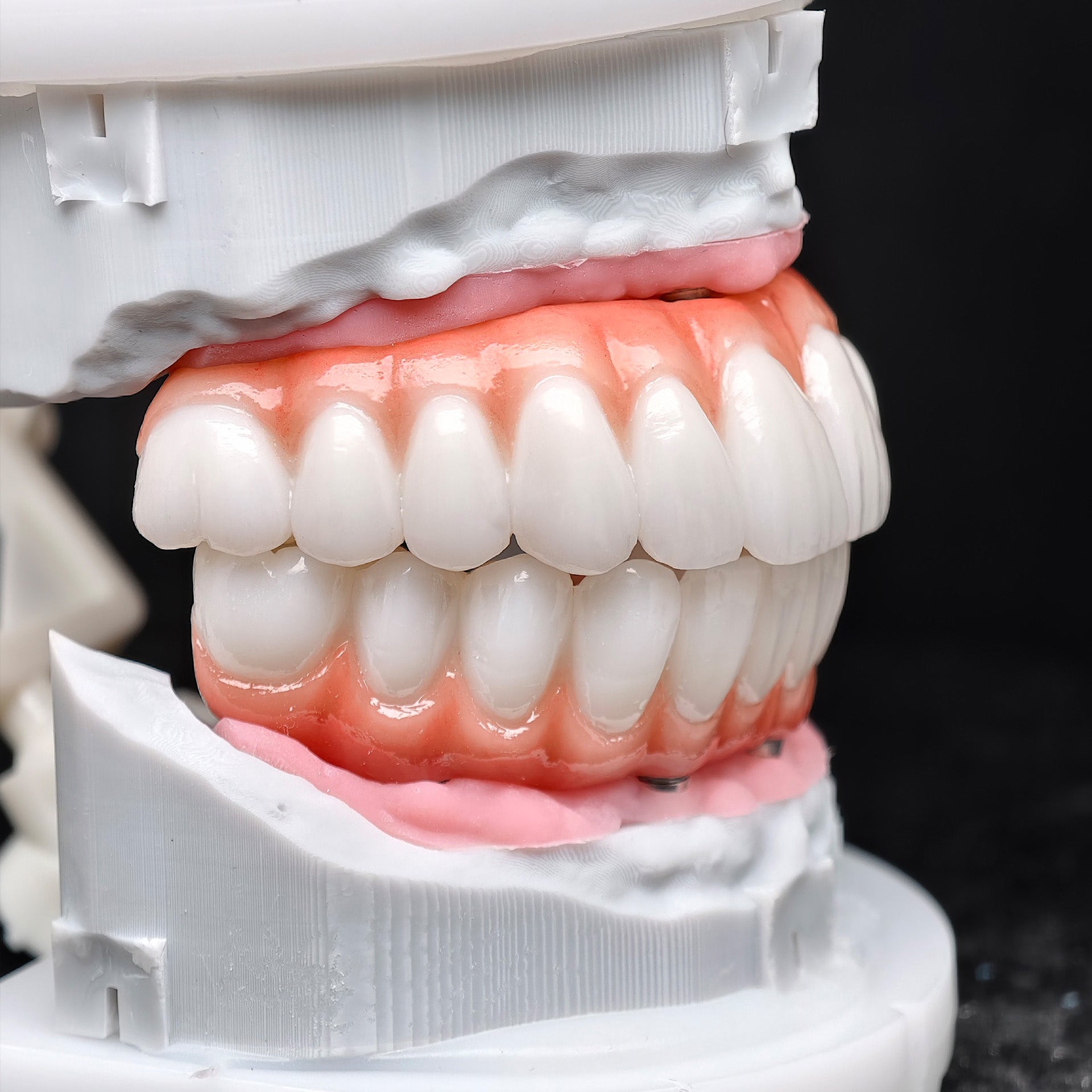 All On 5 Zirconia Bridge With Ti-Base Screw Retained Trying For Full Arch Restoration