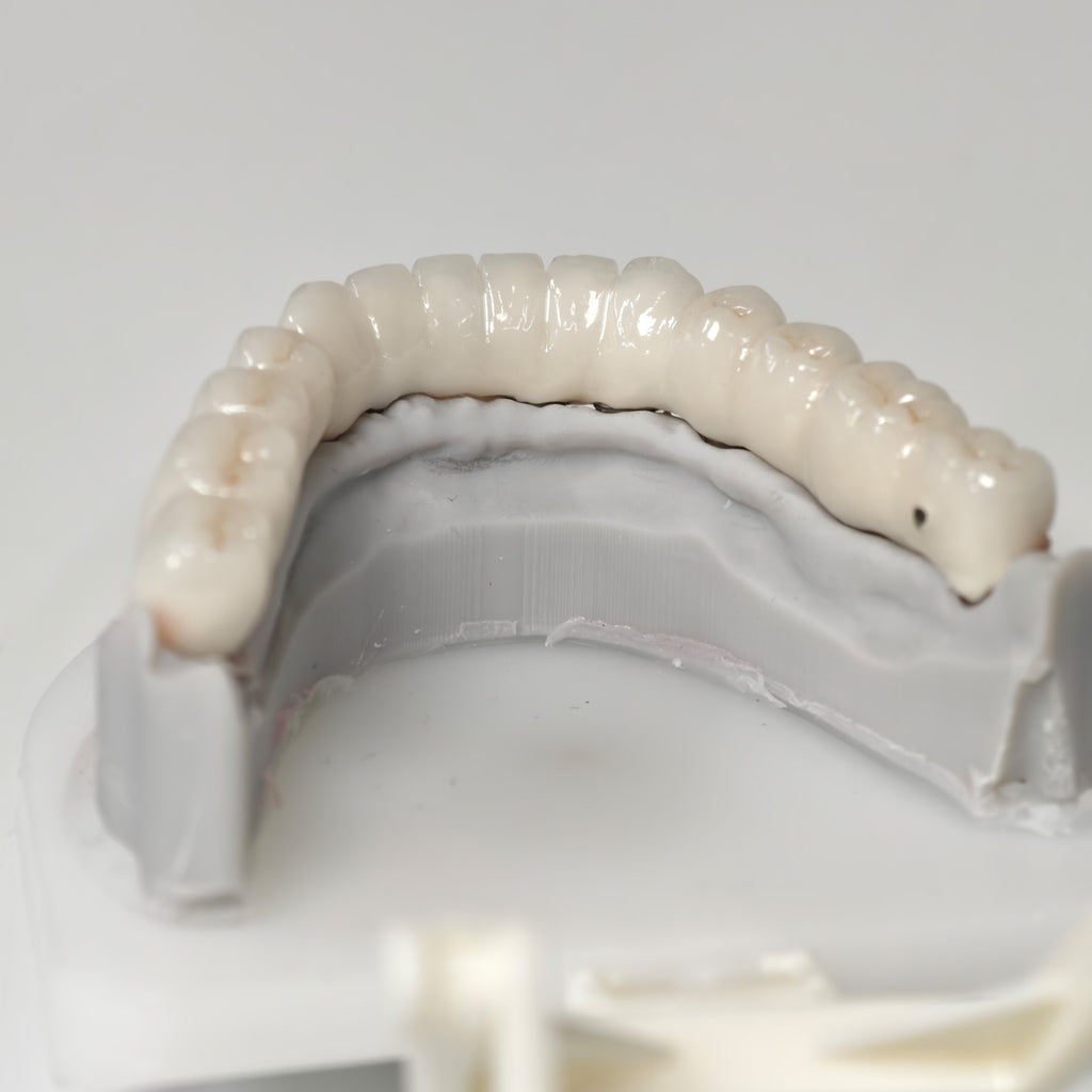 Full-Arch PFM Bridge With Screw Retained