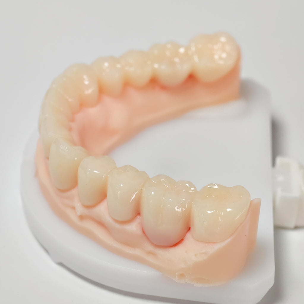 Full-Mouth Segmented PMMA Bridge With Cement Retained