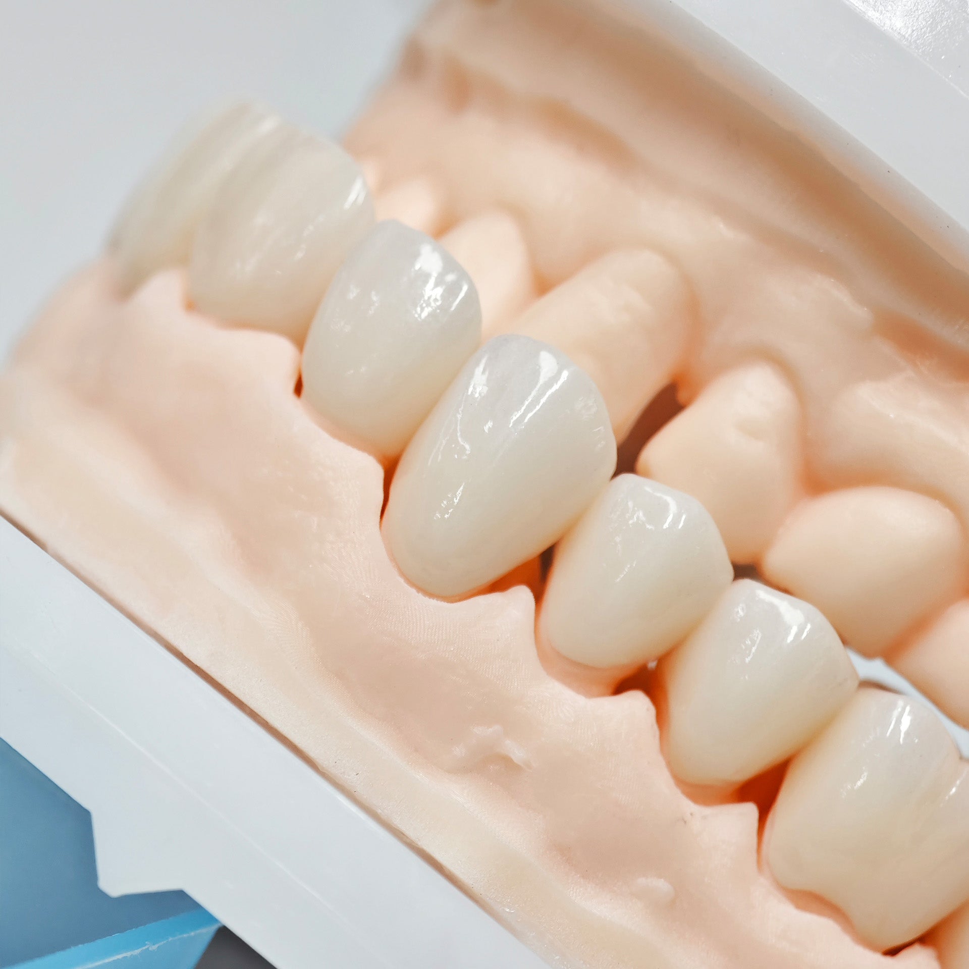 Full-Zriconia Crowns With Cement-Retained