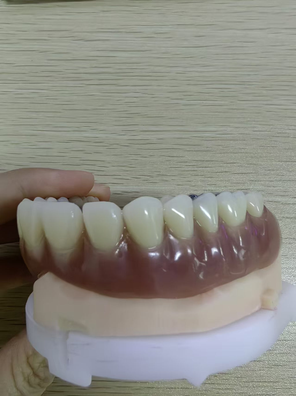 Acrylic Denture Meharry Acrylic Metal On Surface Customized Denture