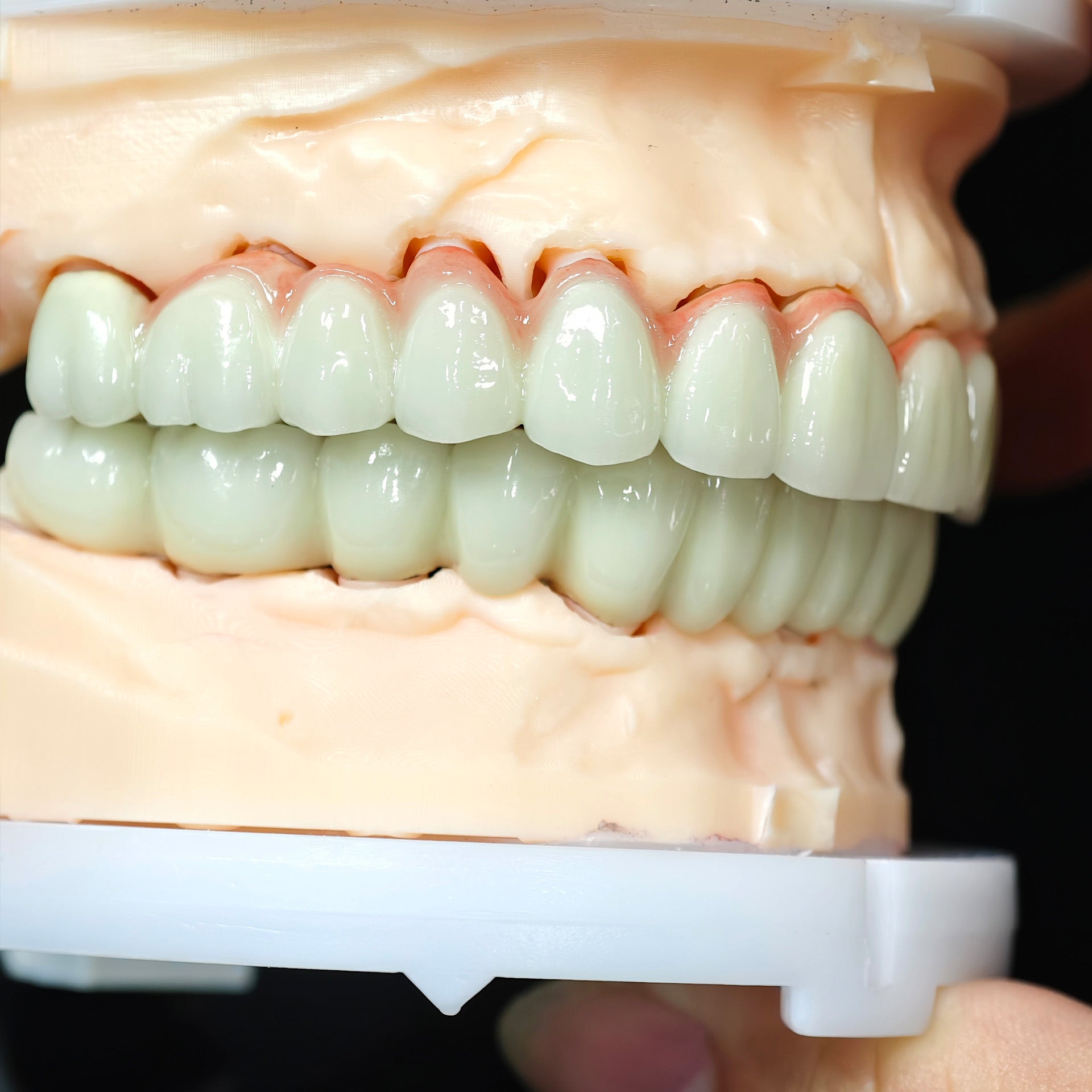 Co - Cr PFM Dental Bridge