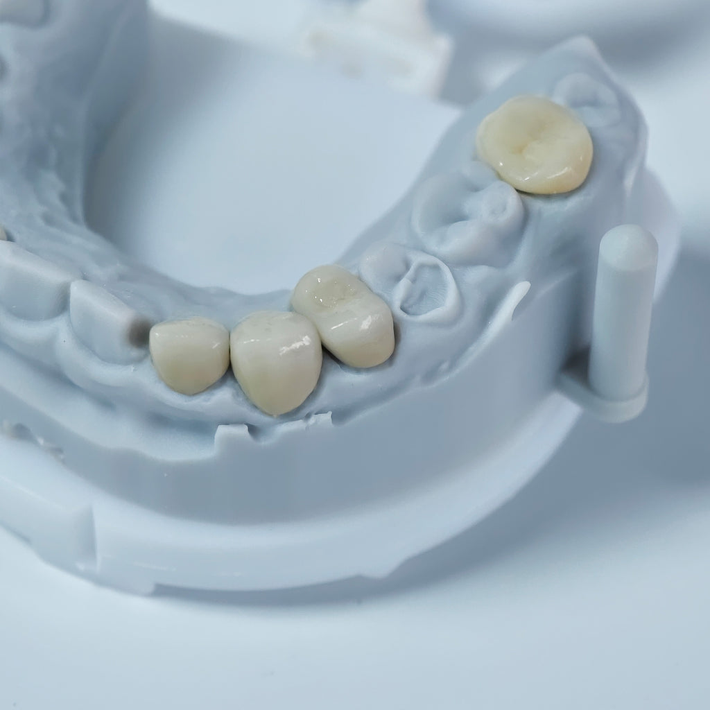 Co - Cr PFM Dental Crowns With Metal Post-And-Core