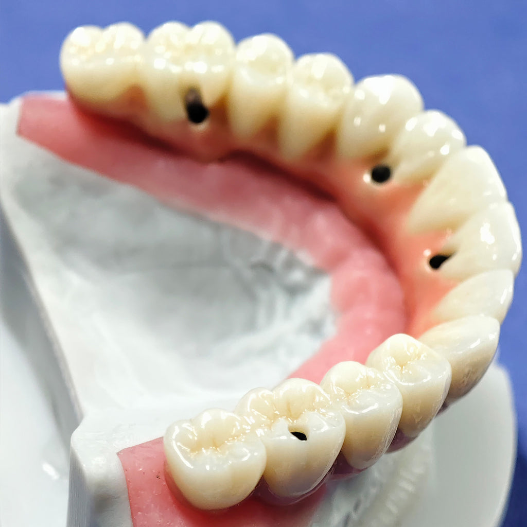 Enhanced Zirconia Crown Malo Bridge