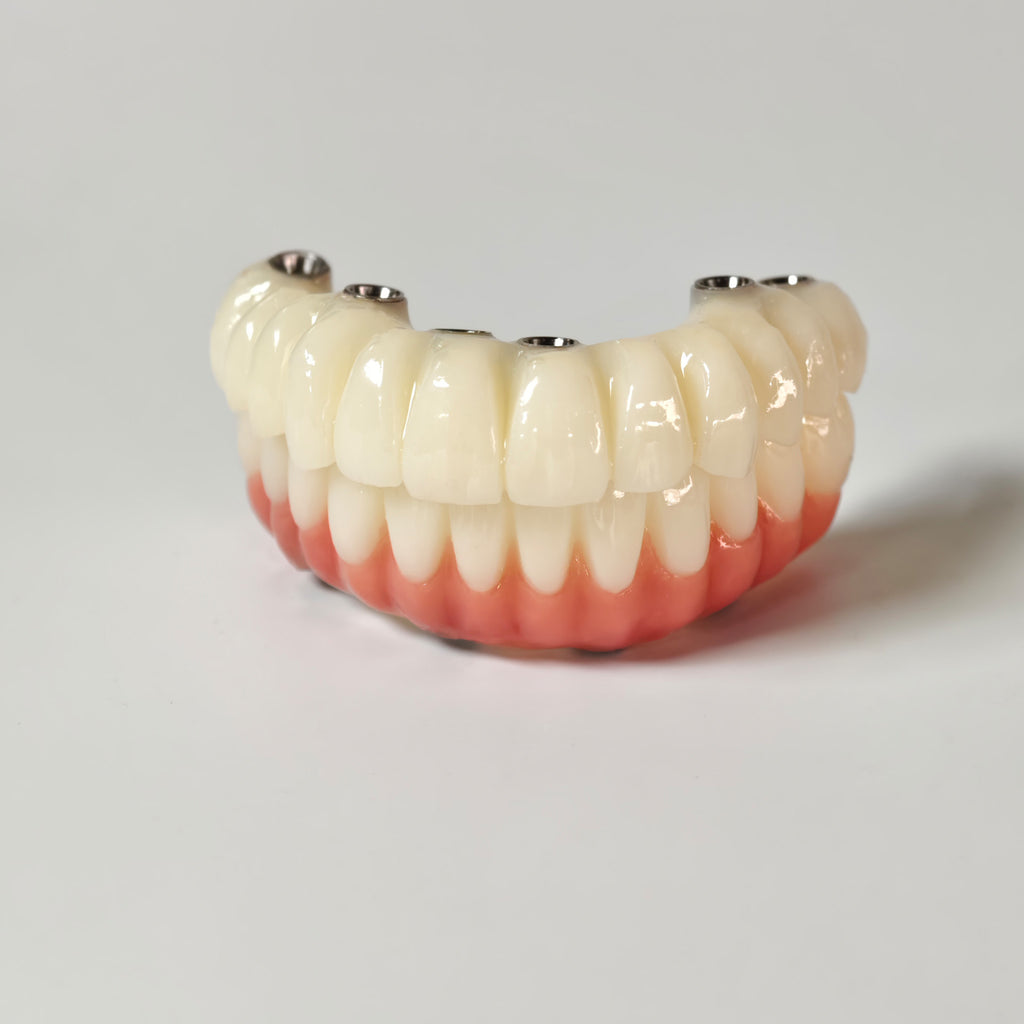 Full-Arch PMMA Bridge With Ti-Base Screw Retained