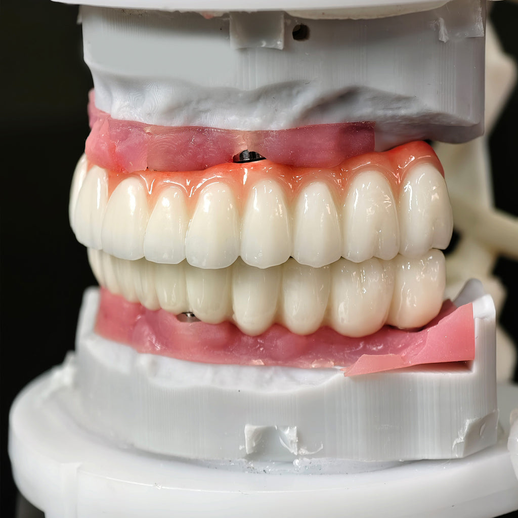 Implant-supported Co - Cr PFM Dental Bridge