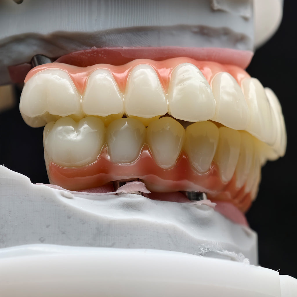 PMMA Bridge With Ti-Base Screw Retained Trying For Full Arch Restoration