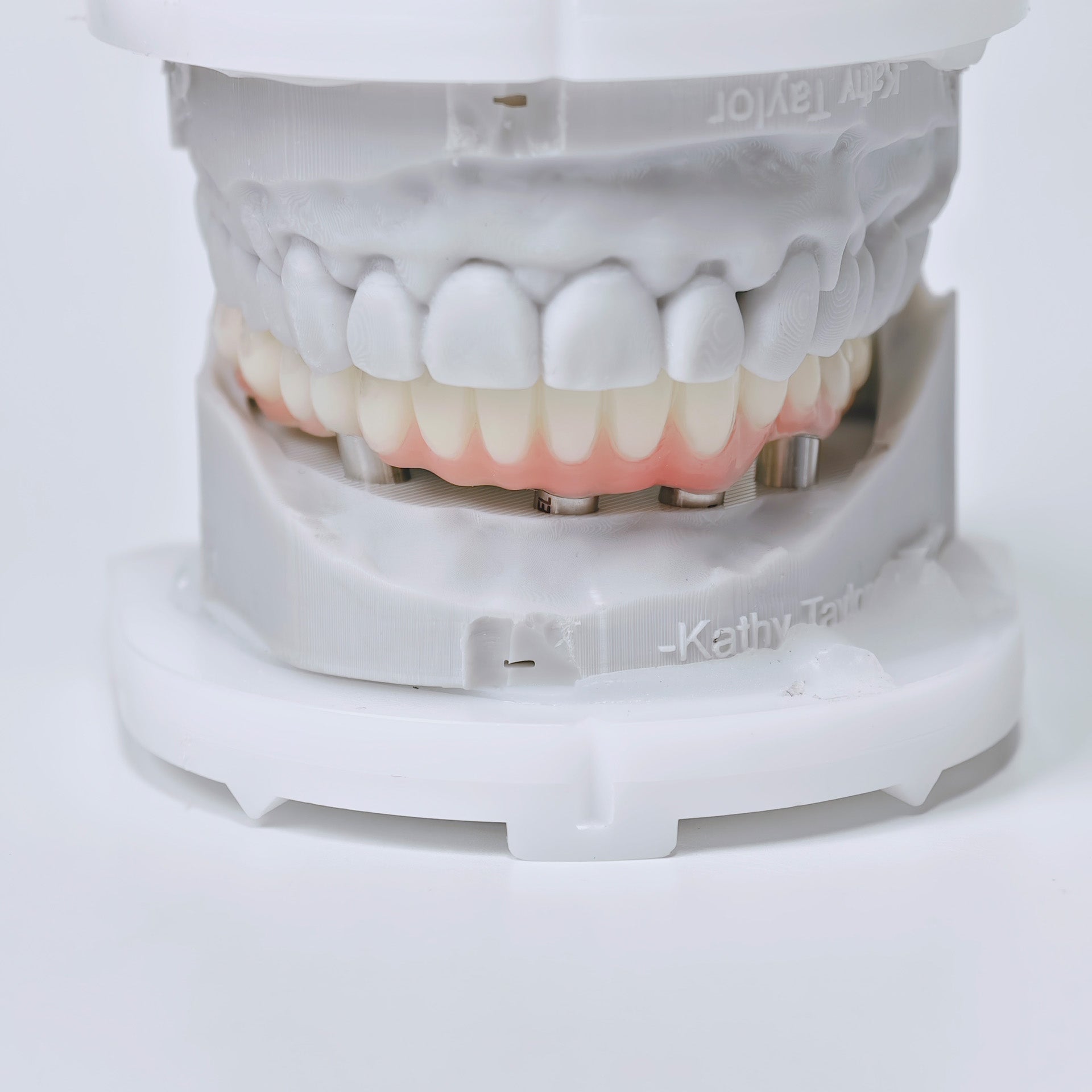 PMMA Bridge With Screw Retained