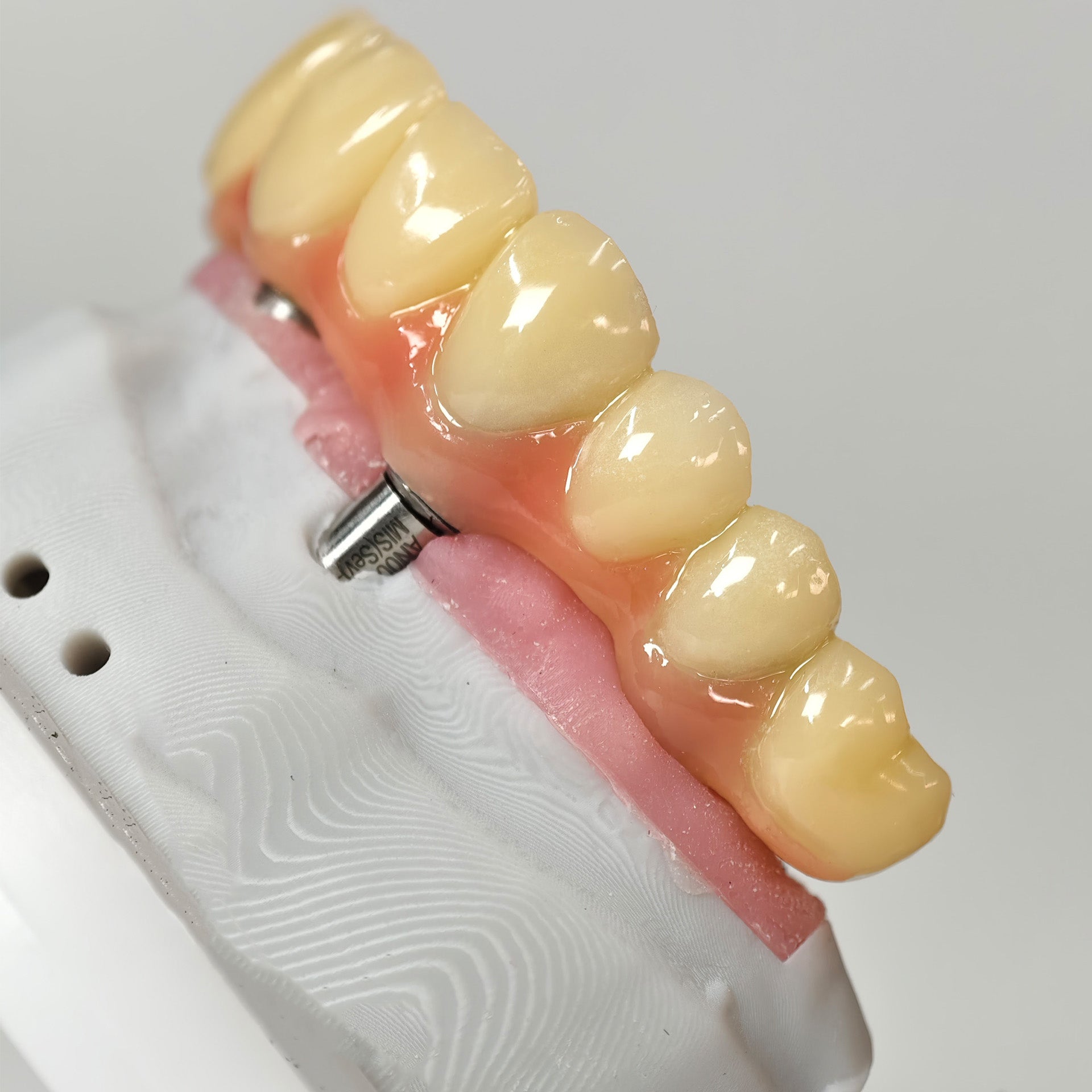 PMMA Bridge With Screw Retained