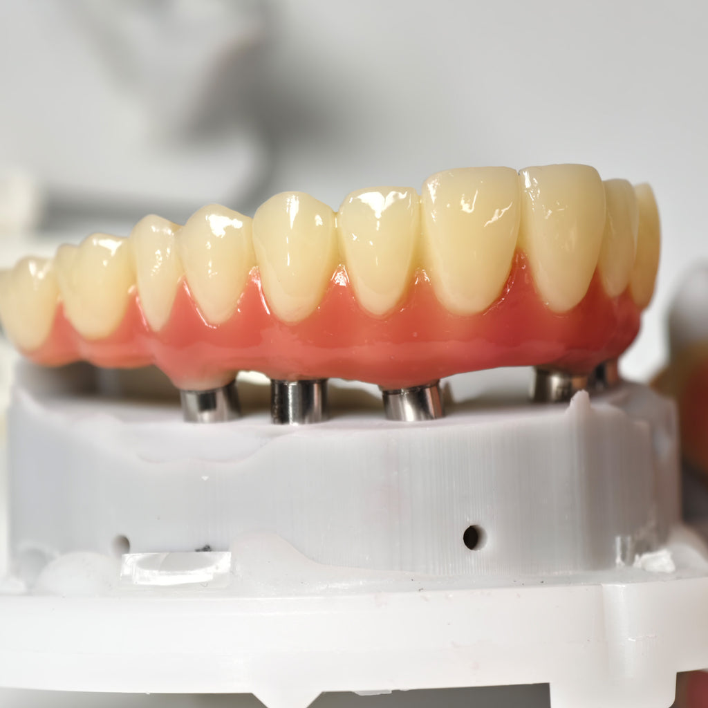 PMMA Bridge With Screw Retained