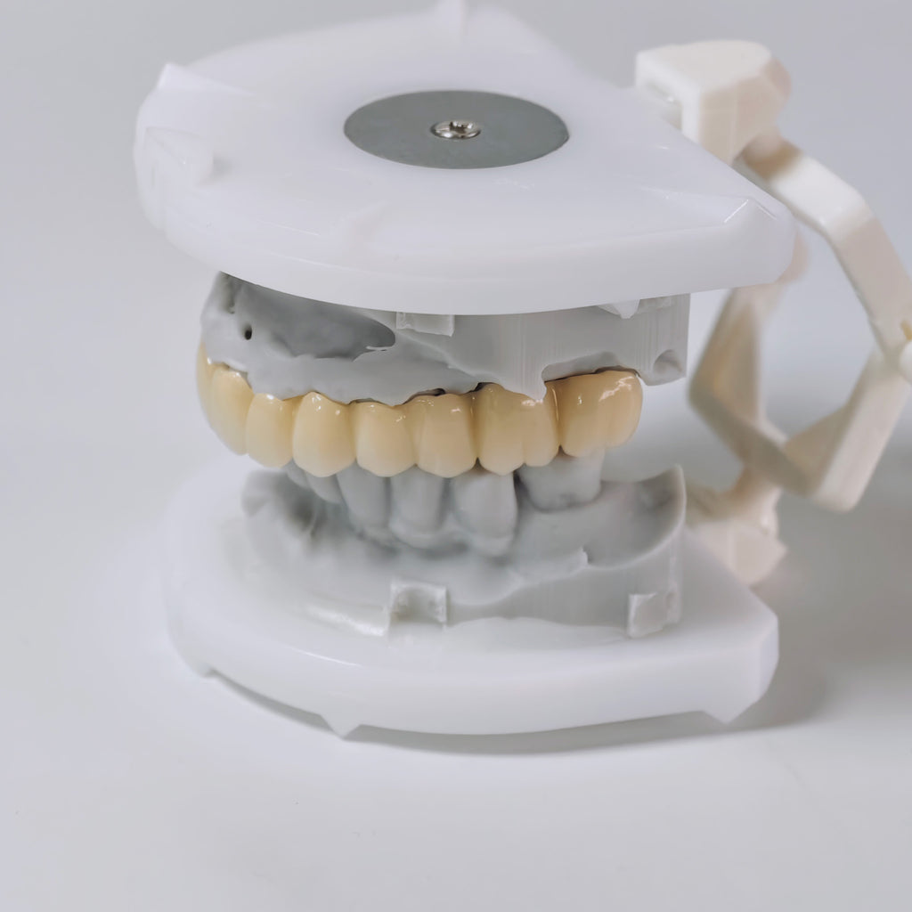 Ti-Bar Titanium Nitride Metal Frame With Zirconia Bridge And Cement Retained