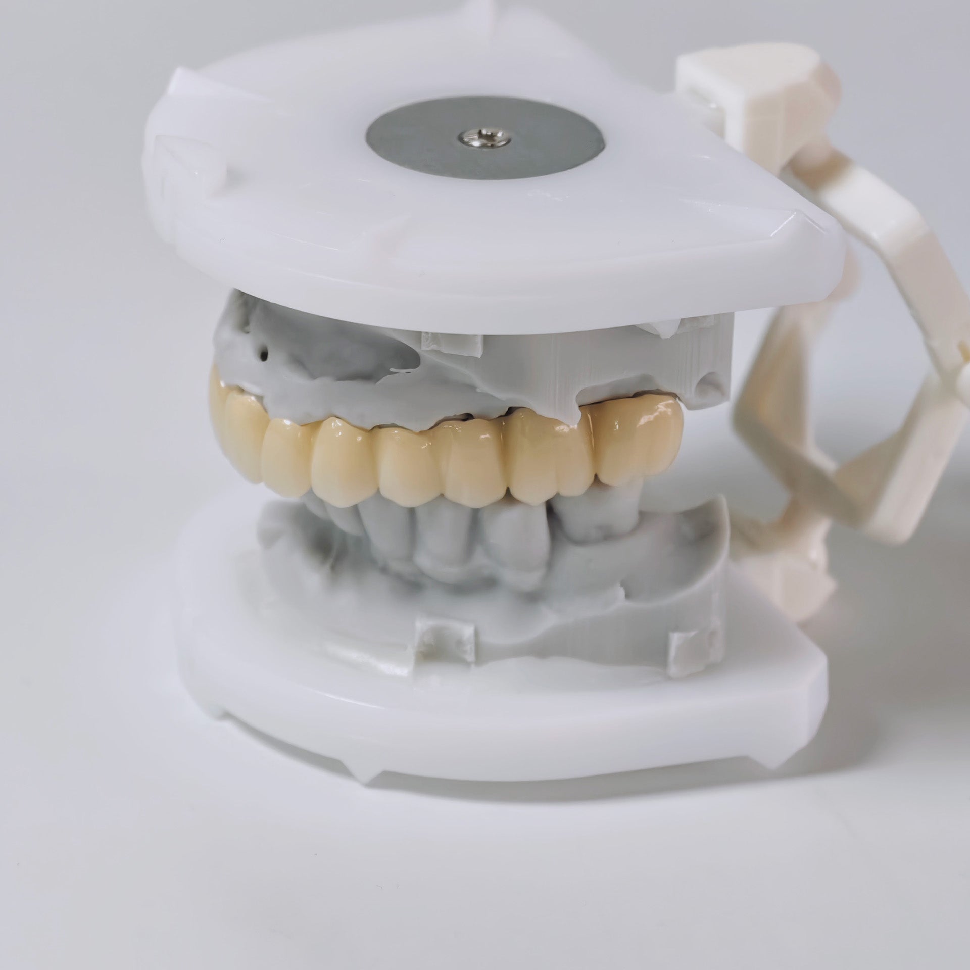 Ti-Bar Titanium Nitride Metal Frame With Zirconia Bridge And Cement Retained