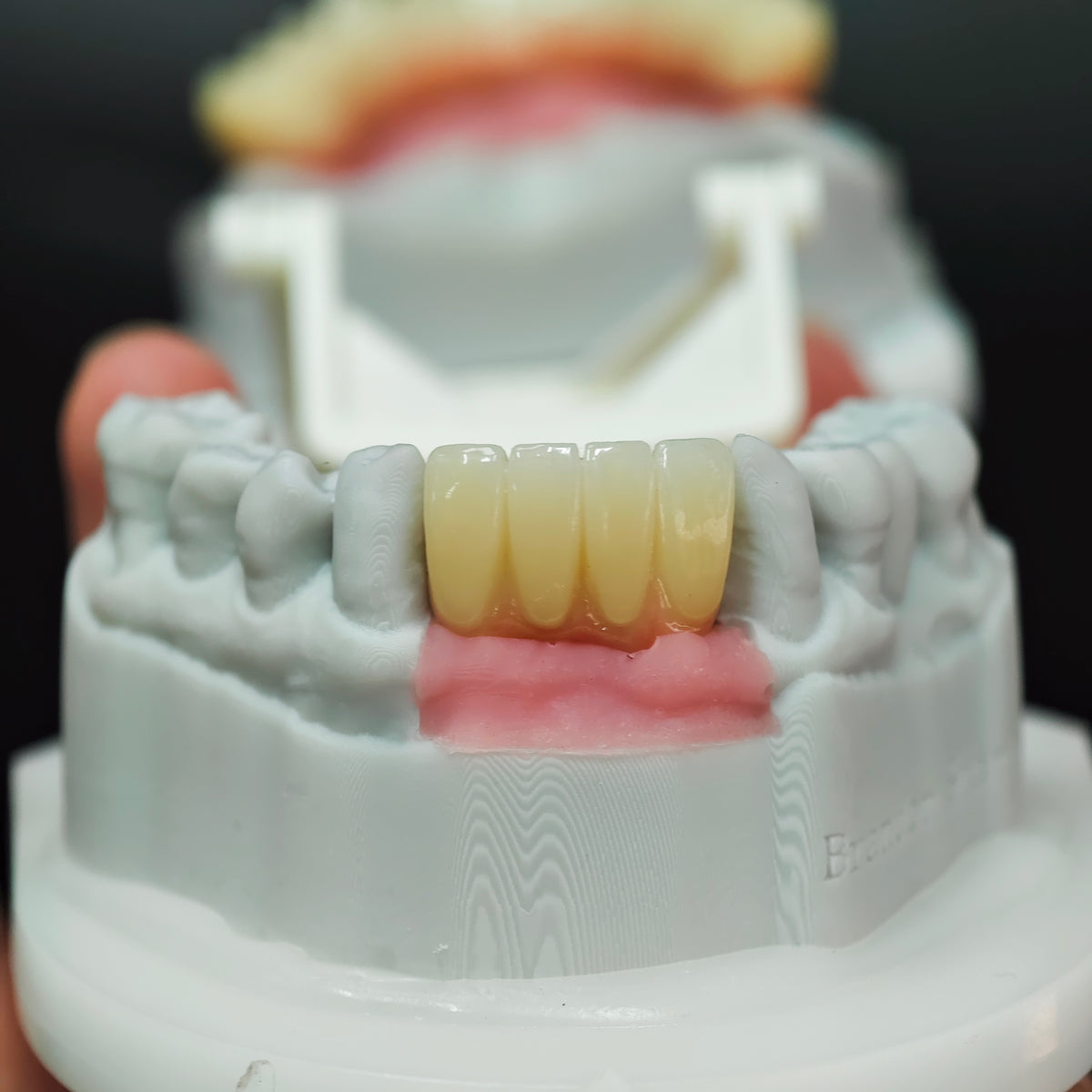 Ti-Bar Titanium Nitride Metal Frame With Zirconia Bridge For Full Arch Restoration