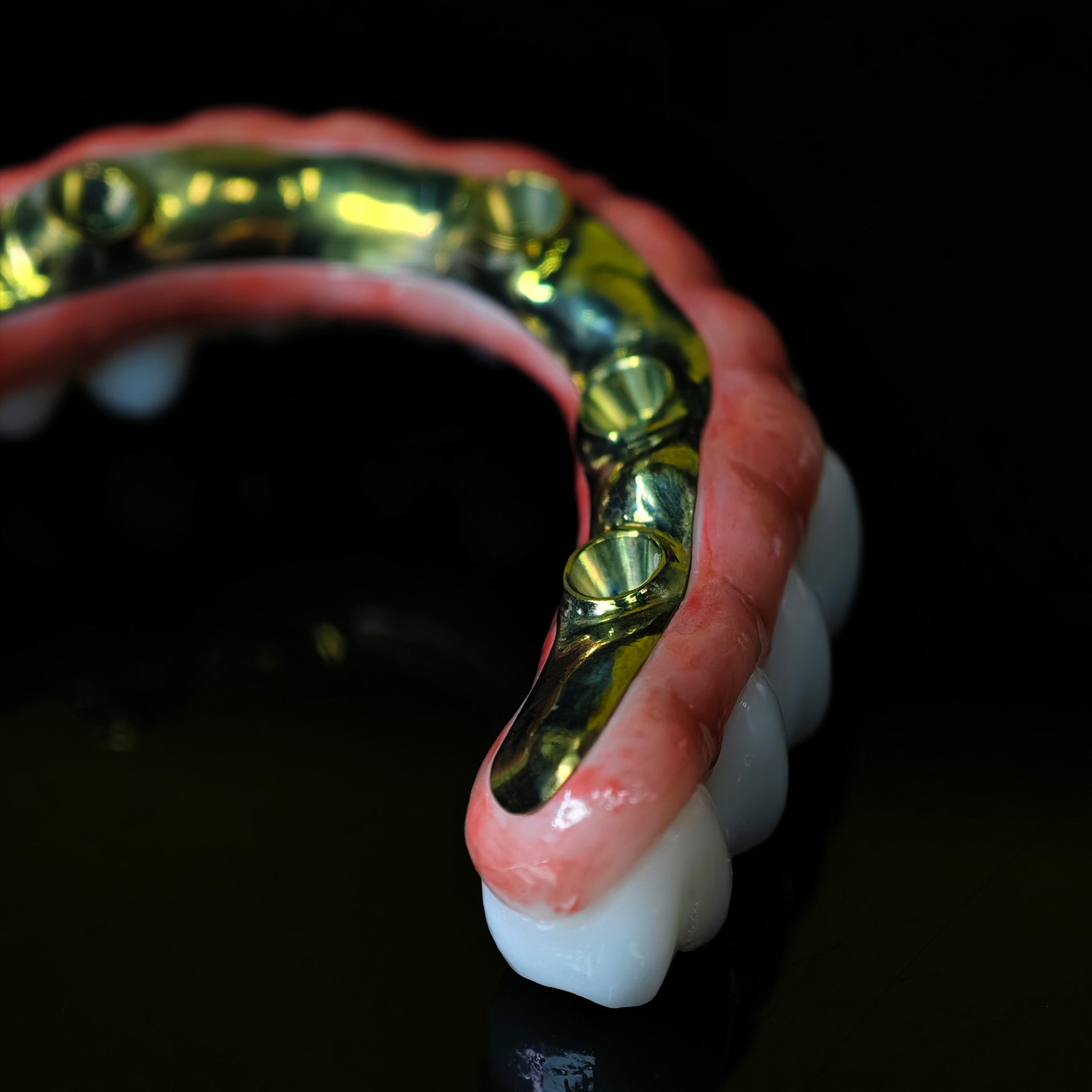 Ti-Bar Titanium Nitride Metal Frame With Zirconia Bridge For Full Arch Restoration