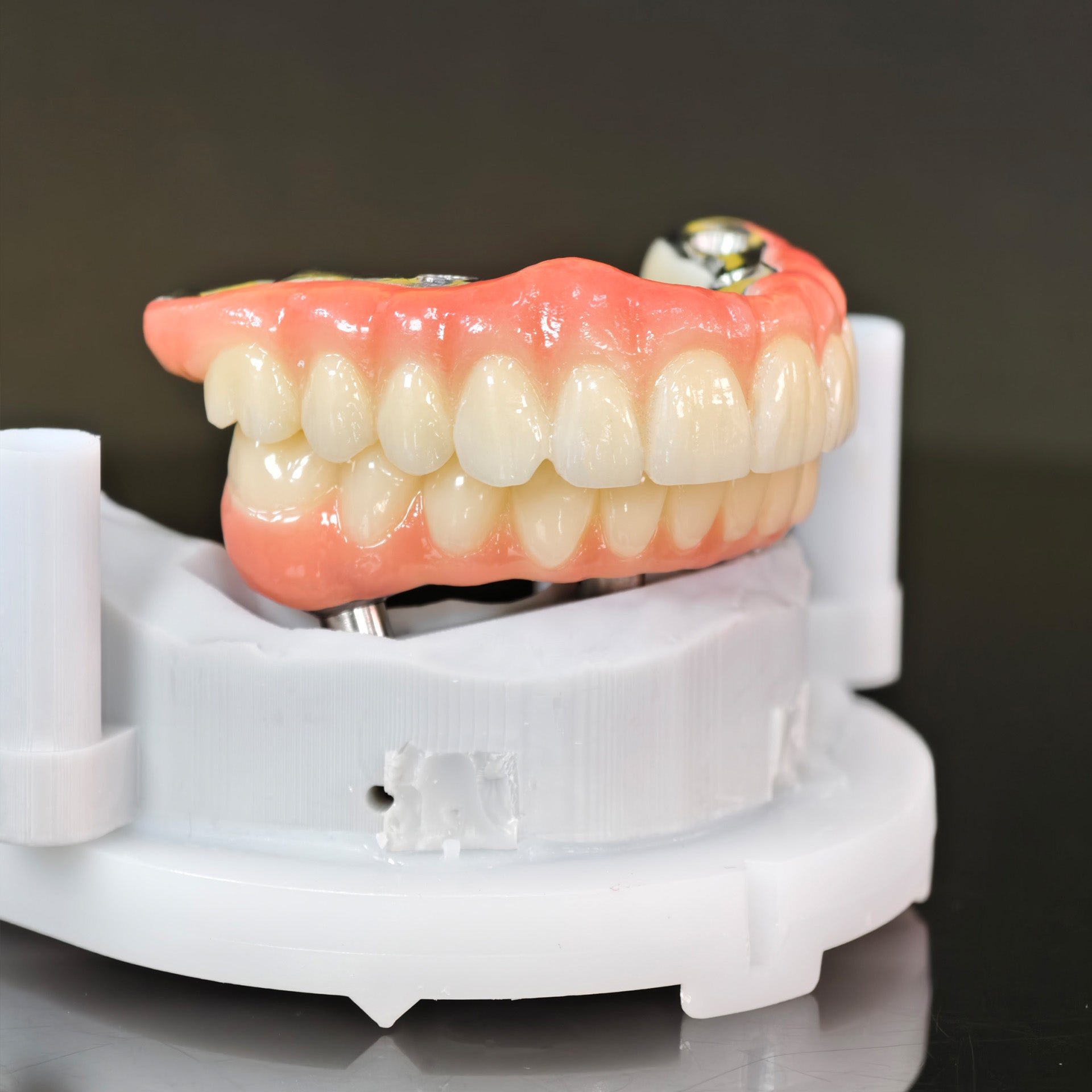 Ti-Bar Titanium Nitride Metal Frame With Zirconia Bridge For Full Arch Restoration