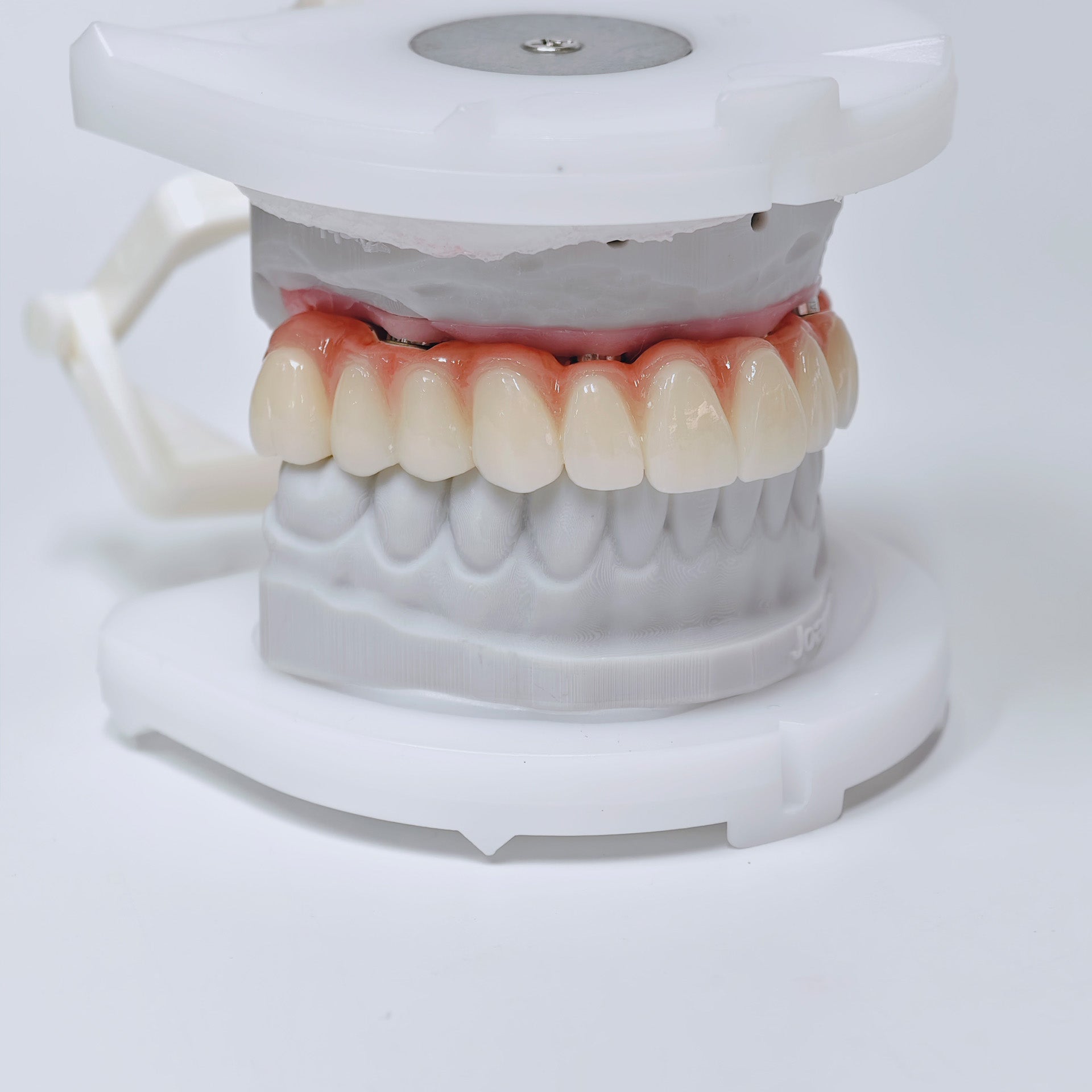 Ti-Bar Titanium Nitride Metal Frame With Zirconia Bridge For Full Arch Restoration