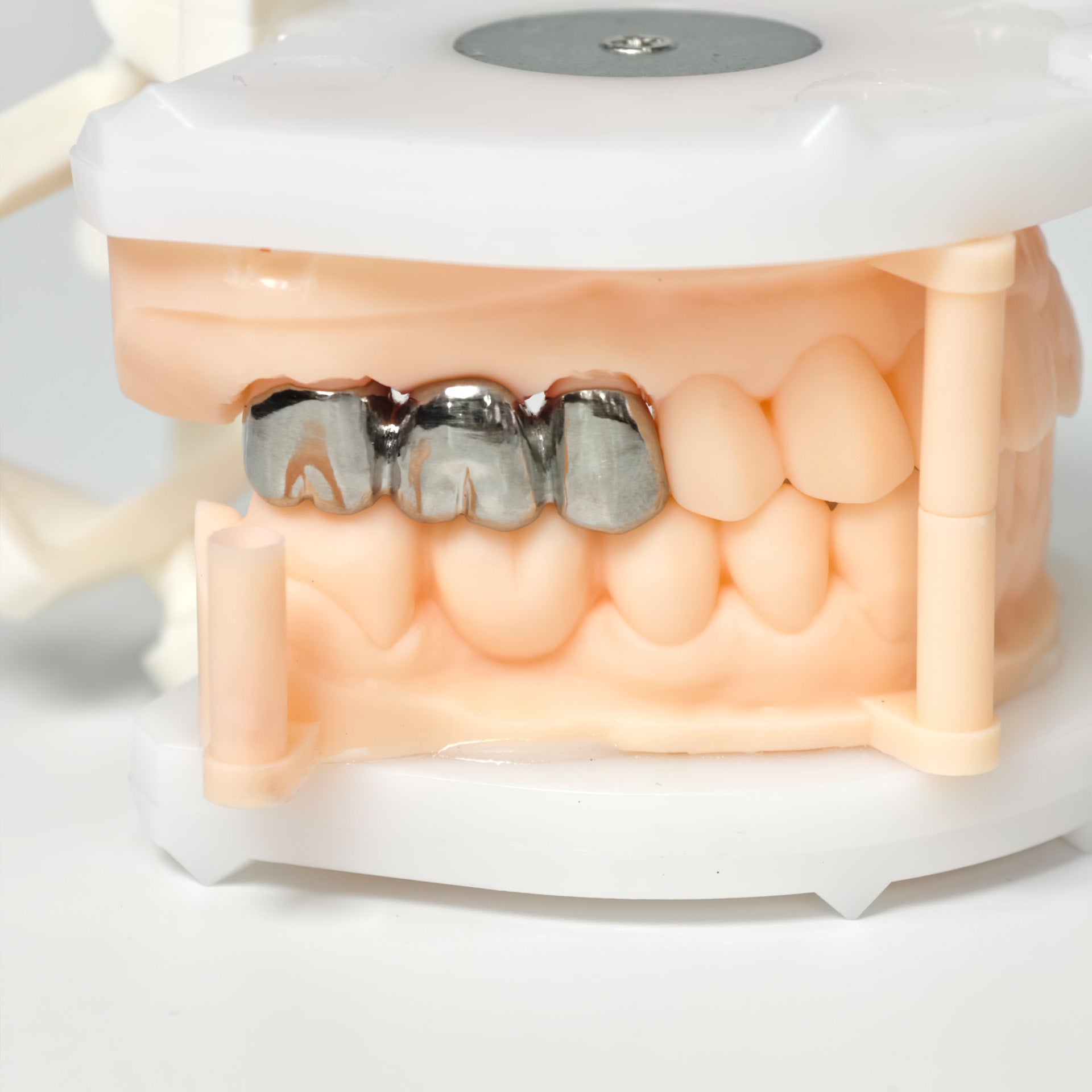 Titanium Crown With Cement Retained