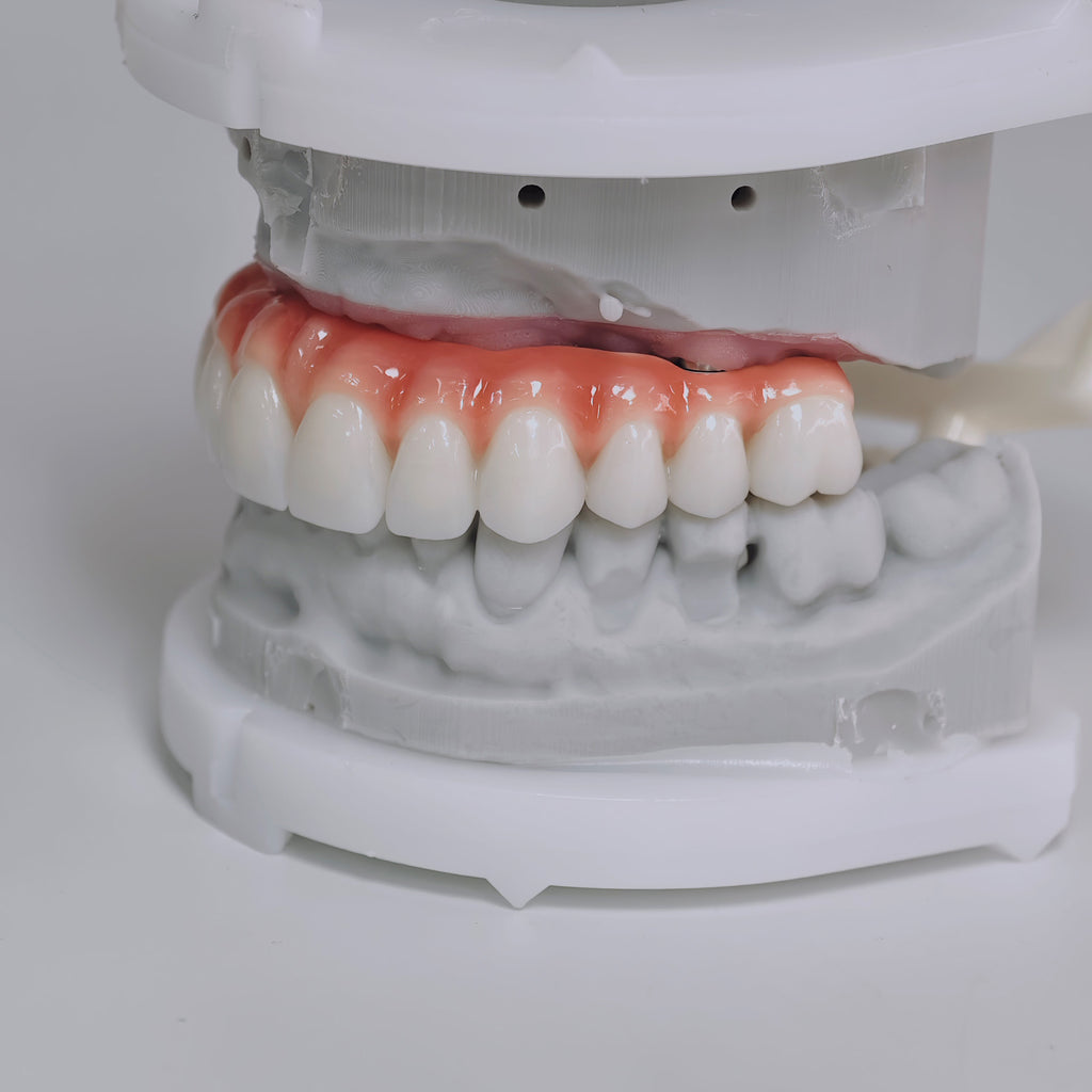 Zirconia-Enamel Hybrid Malo Bridge Aesthetic