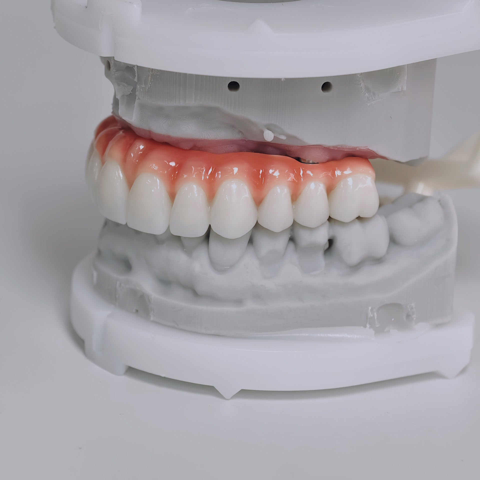 Zirconia-Enamel Hybrid Malo Bridge Aesthetic