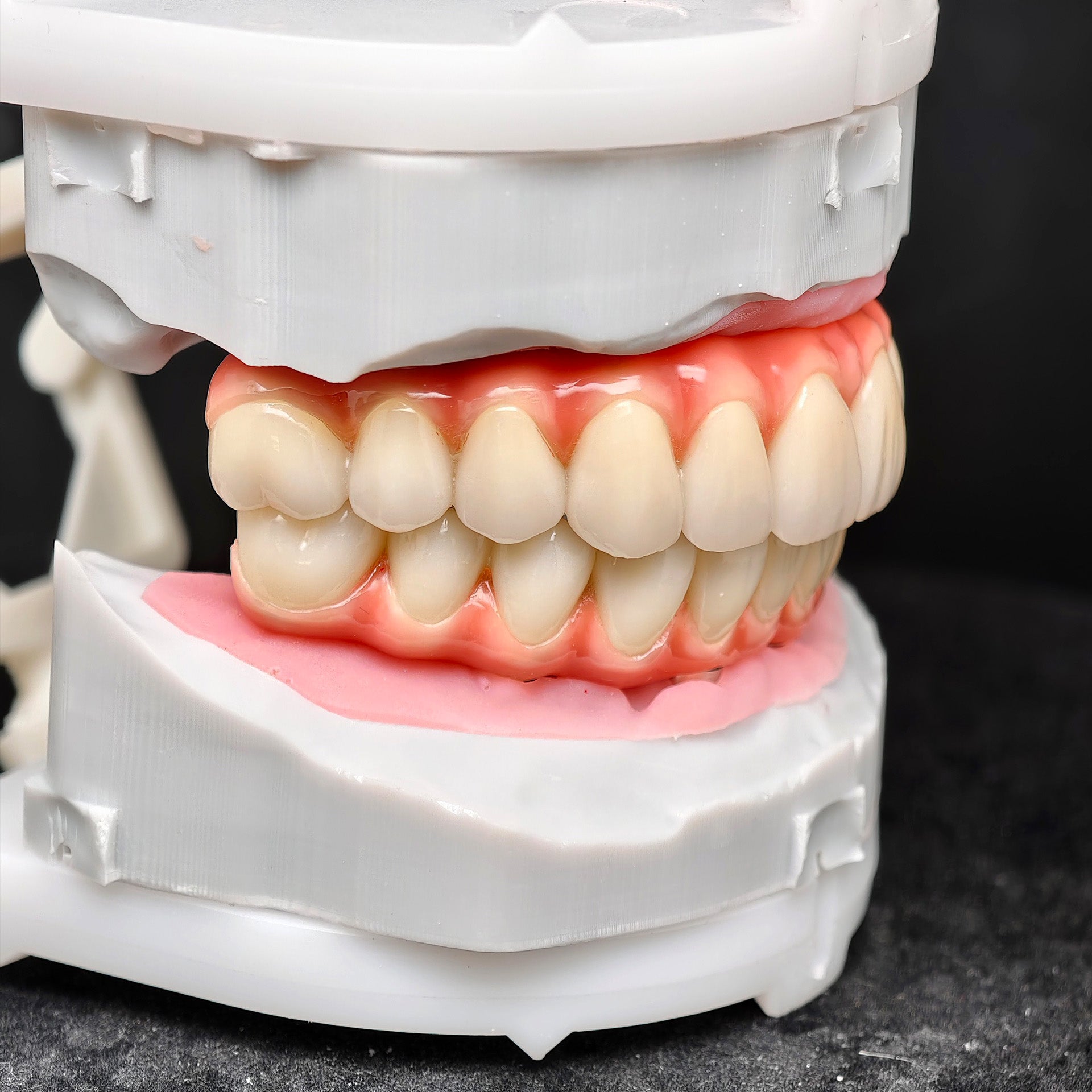 Zirconia-Enamel Hybrid Malo Bridge