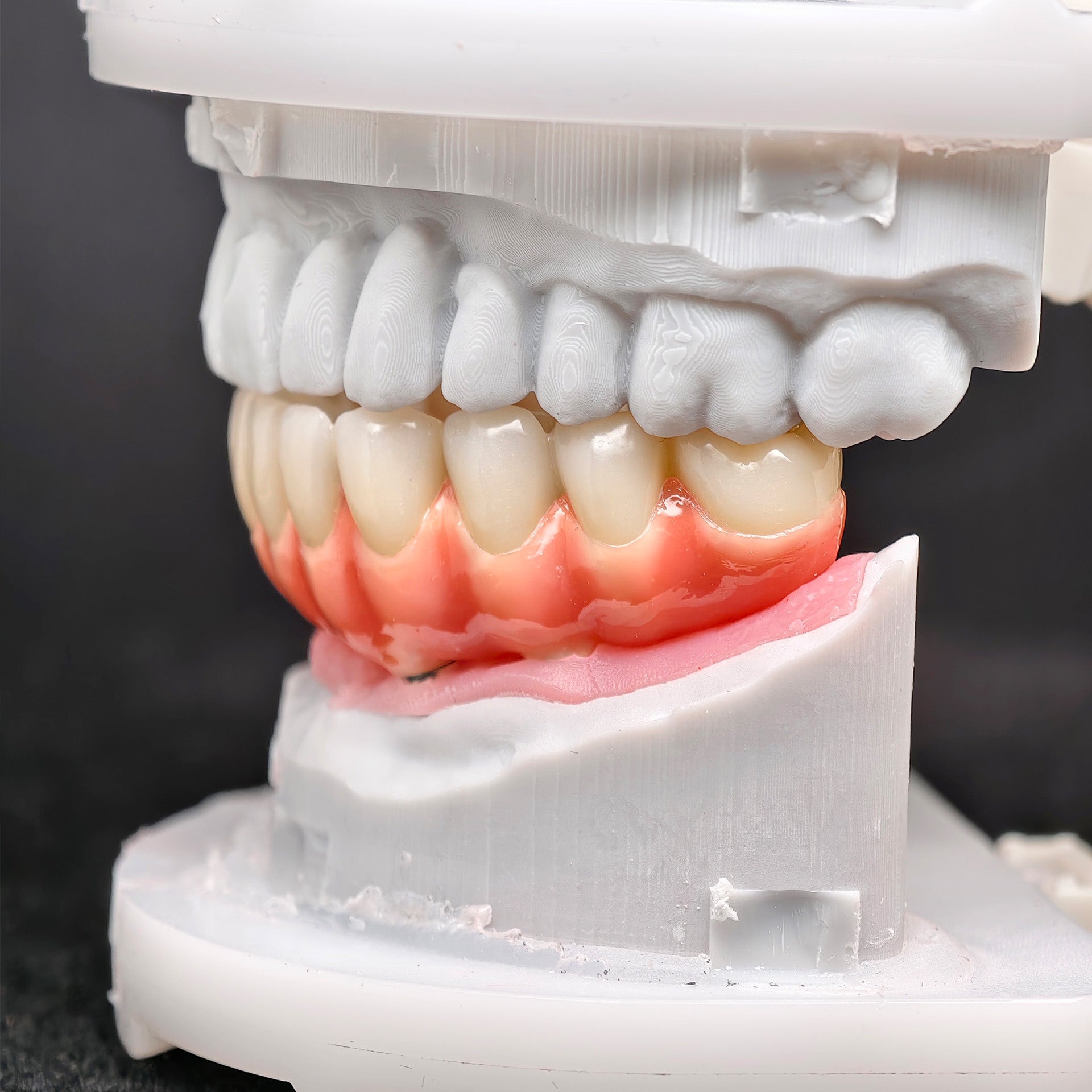 Zirconia-Enamel Hybrid Malo Bridge