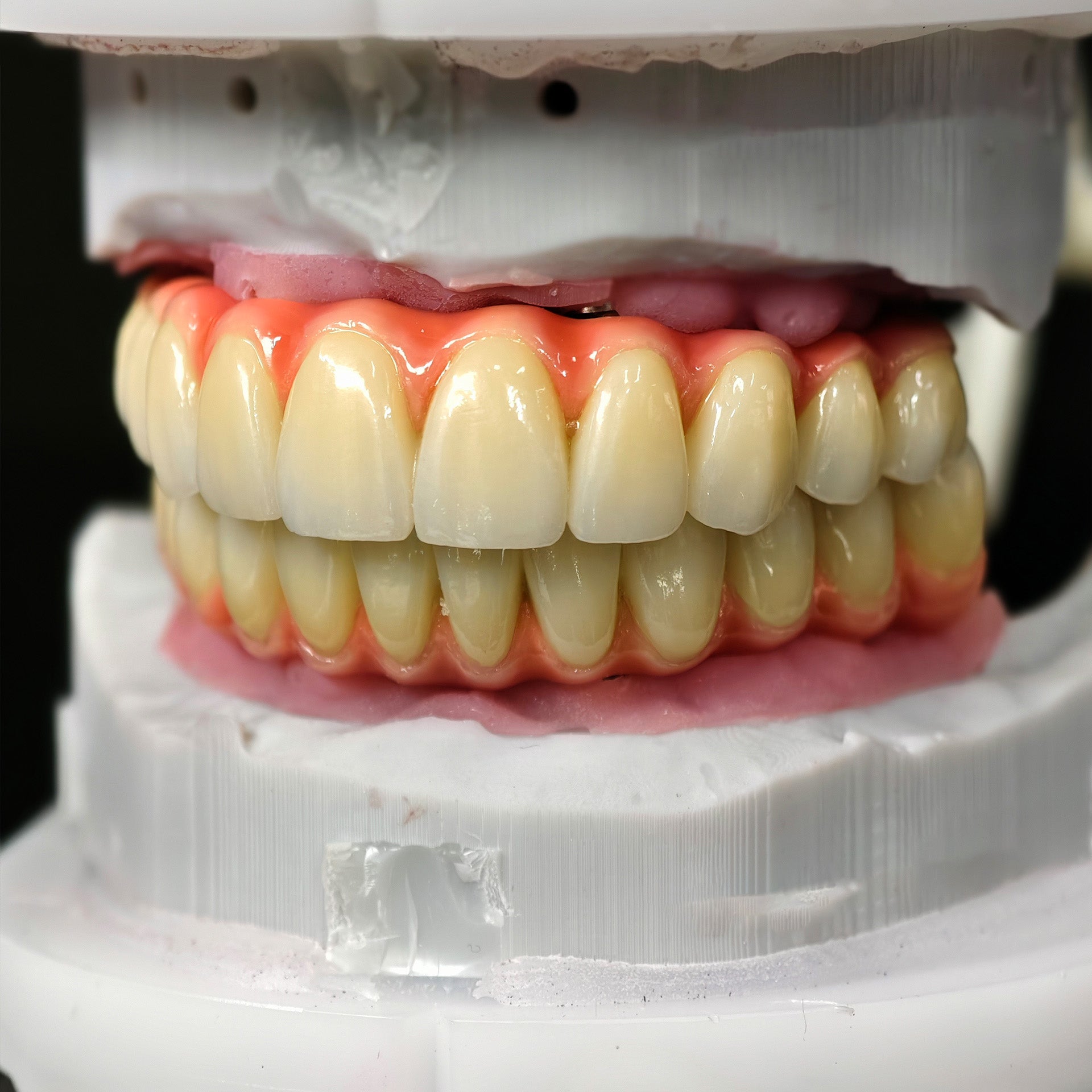 Zirconia-Enamel Hybrid Malo Bridge