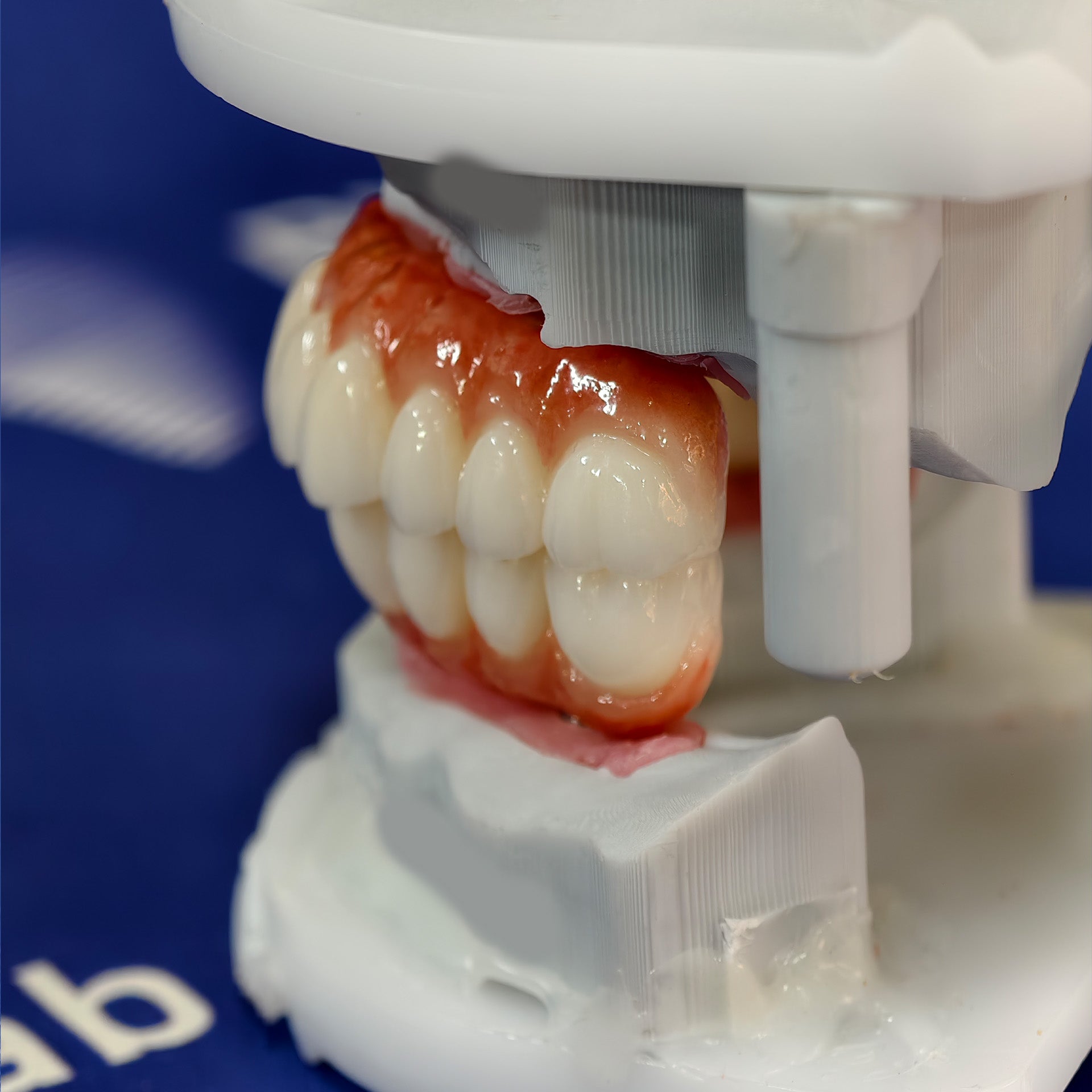All On 4 Zirconia Bridge With Ti-Base Screw Retained Trying For Full Arch Restoration