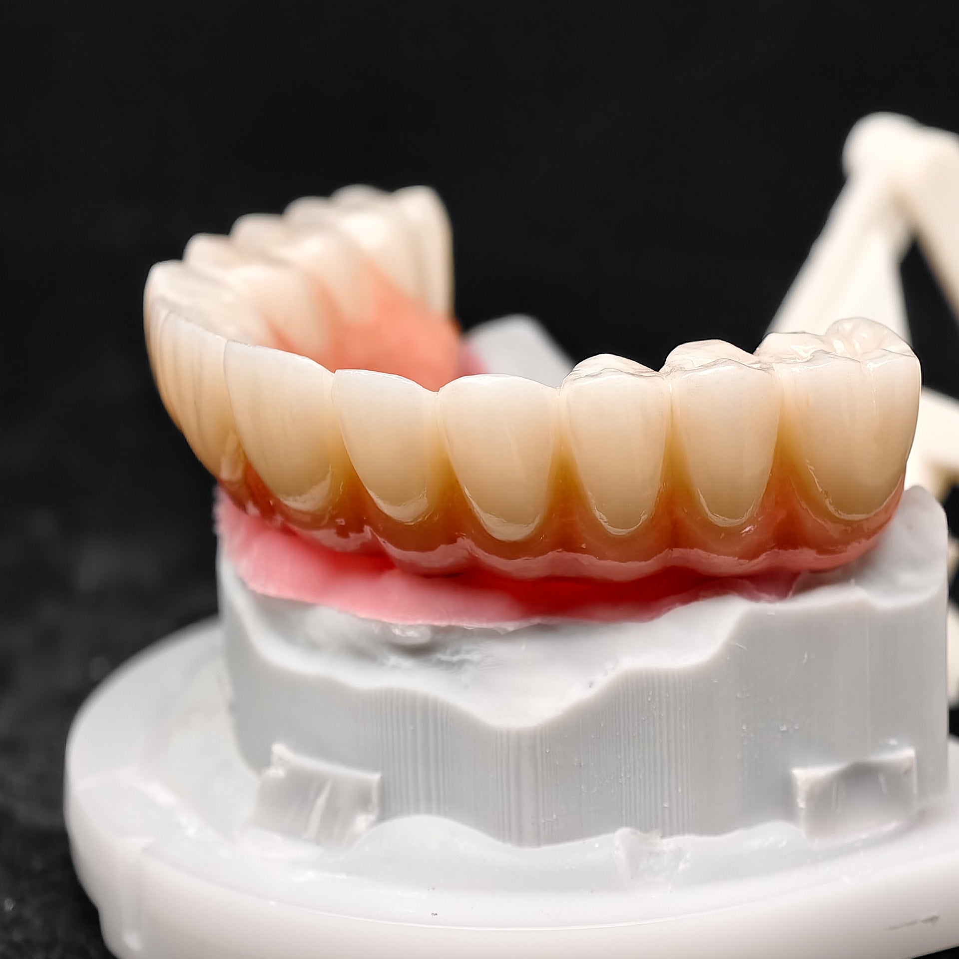 All On 4 Zirconia Bridge With Ti-Base Screw Retained Trying For Full Arch Restoration
