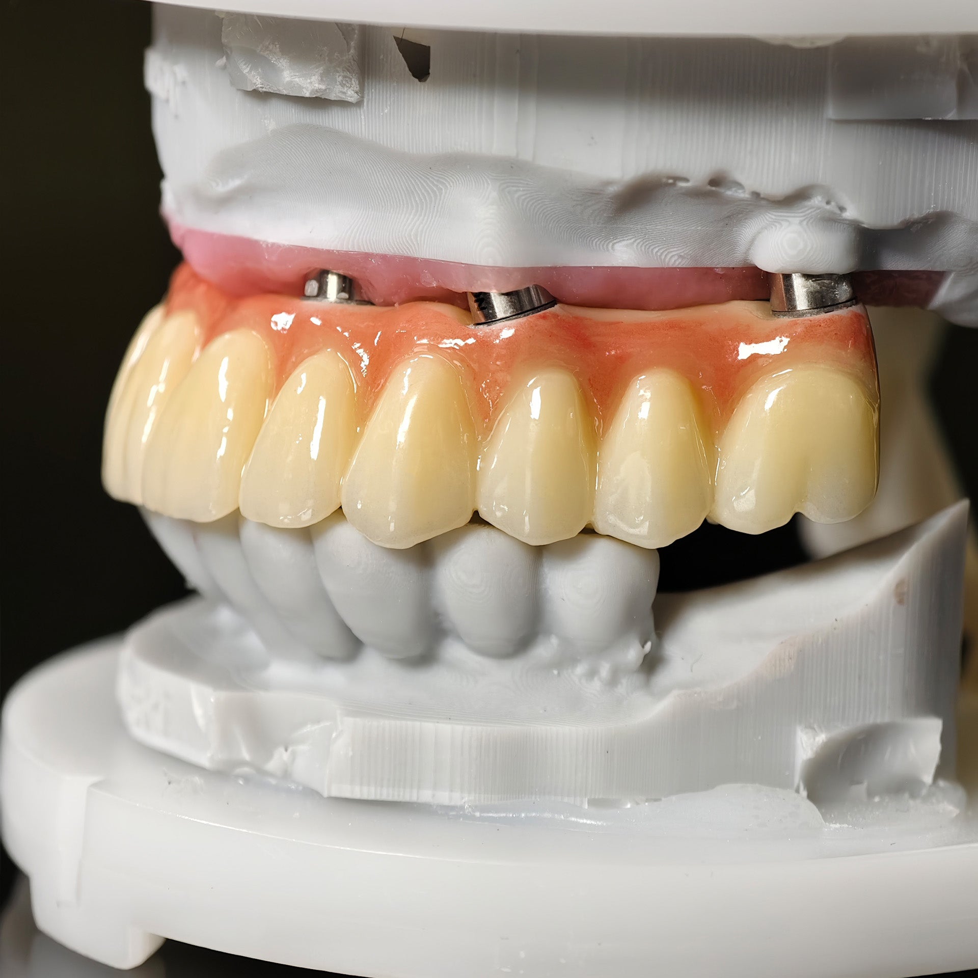 All On 5 Zirconia Bridge With Ti-Base Screw Retained Trying For Full Arch Restoration