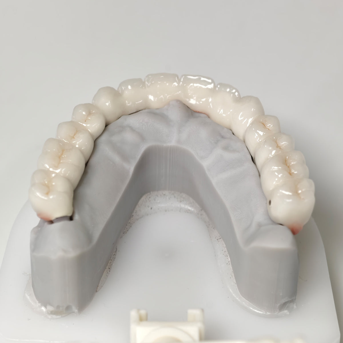 Full-Arch PFM Bridge With Screw Retained