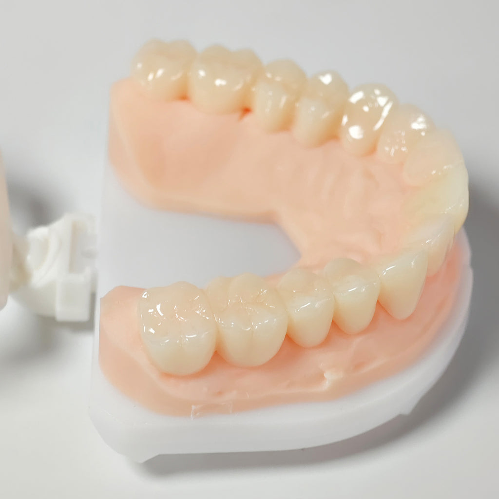 Full-Mouth Segmented PMMA Bridge With Cement Retained