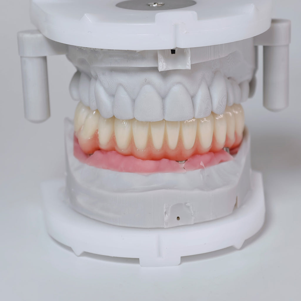 All On 4 Zirconia Bridge With Ti-Base Screw Retained