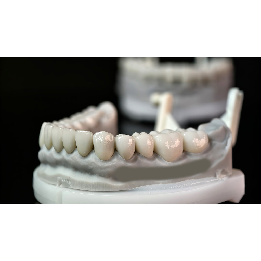 Ceramic Veneers And Crown With Cement Retained