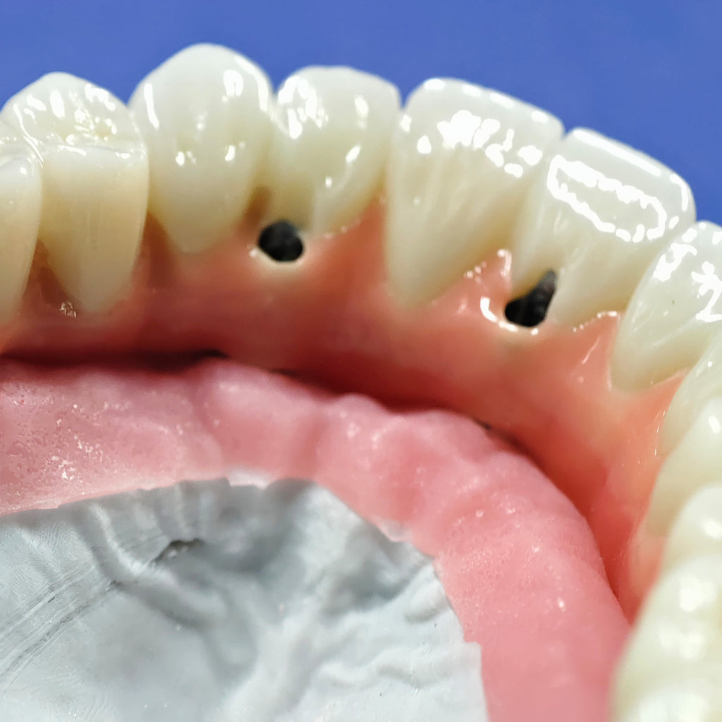 Enhanced Zirconia Crown Malo Bridge