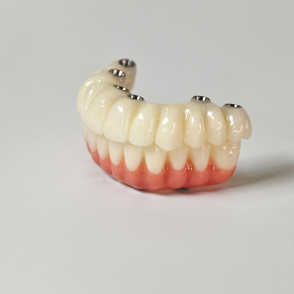 Full-Arch PMMA Bridge With Ti-Base Screw Retained