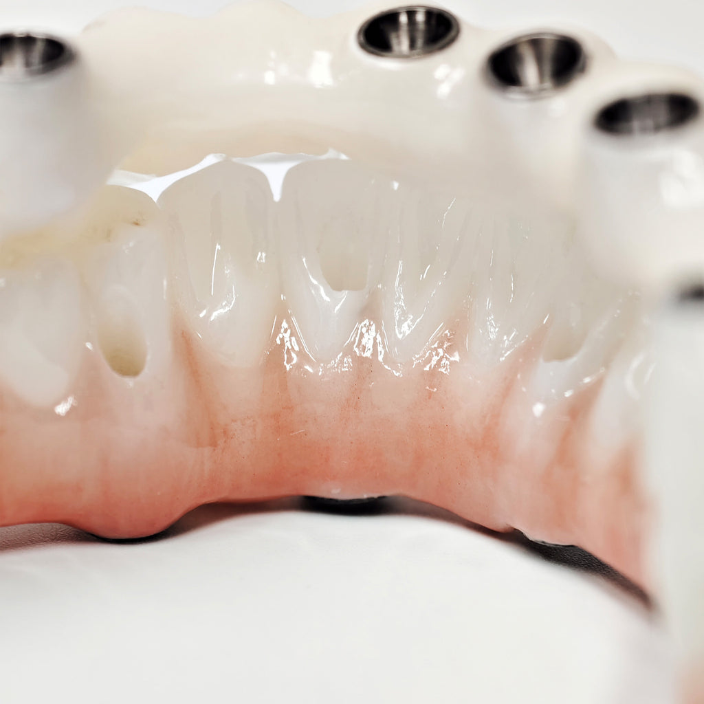 Full-Arch Zirconia Bridge With Ti-Base Abutment