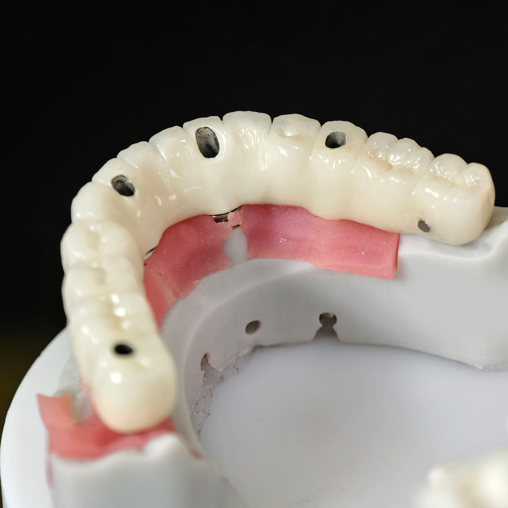 Implant-supported Co - Cr PFM Dental Bridge