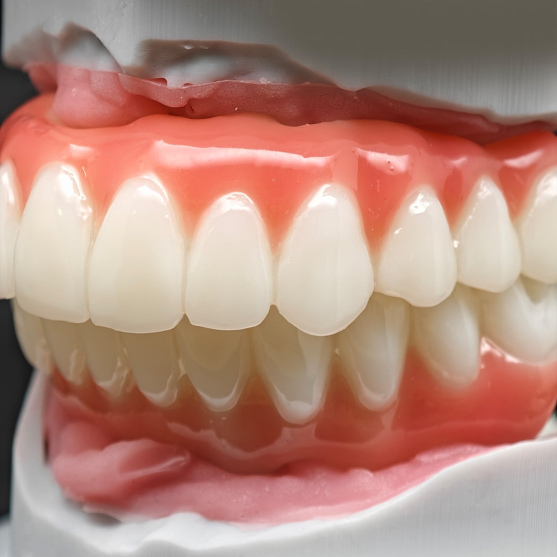PMMA Bridge With Ti-Base Screw Retained Trying For Full Arch Restoration