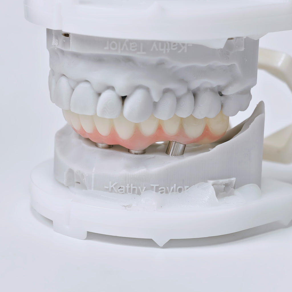 PMMA Bridge With Screw Retained