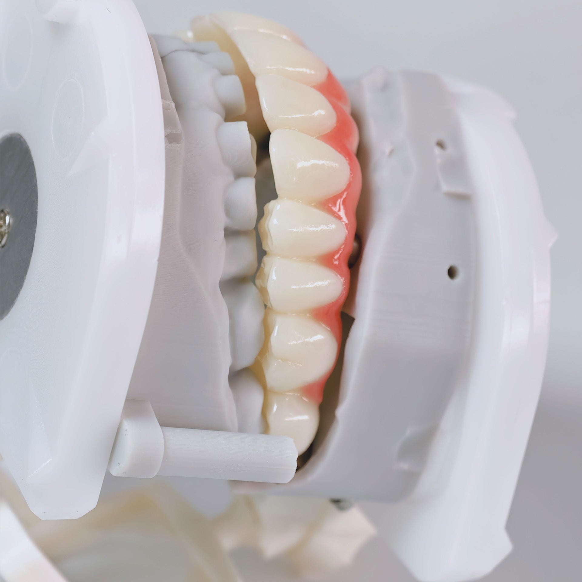 PMMA Bridge With Screw Retained