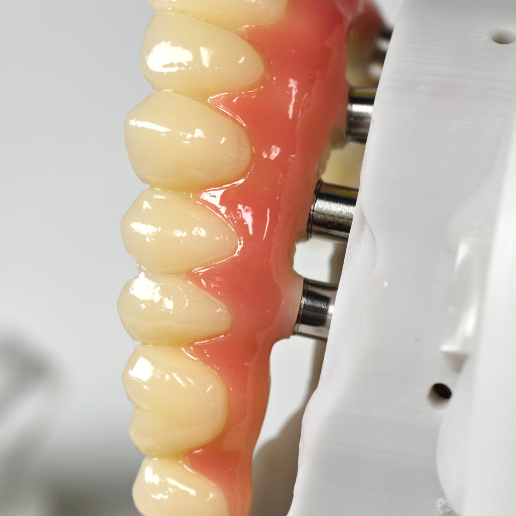 PMMA Bridge With Screw Retained