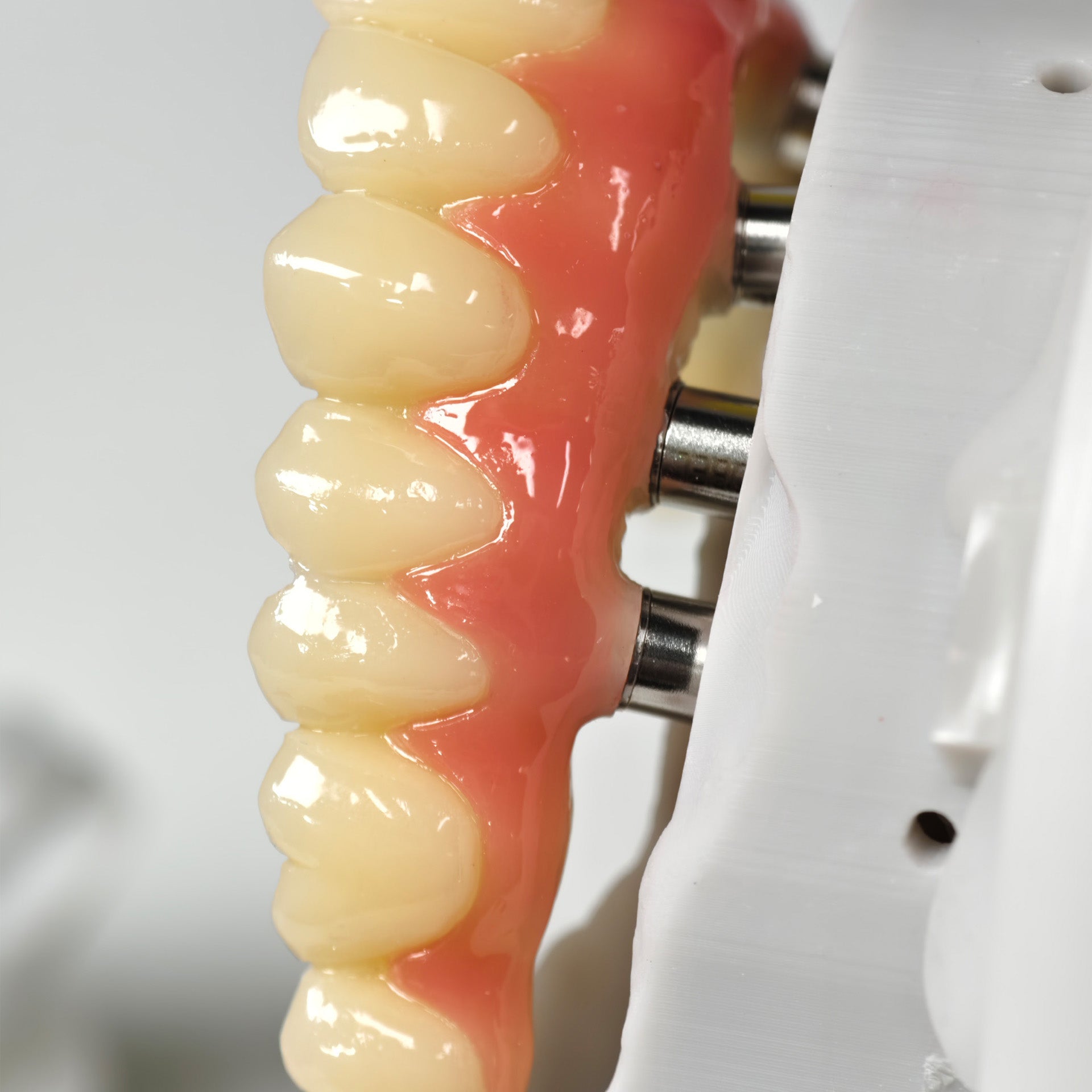 PMMA Bridge With Screw Retained