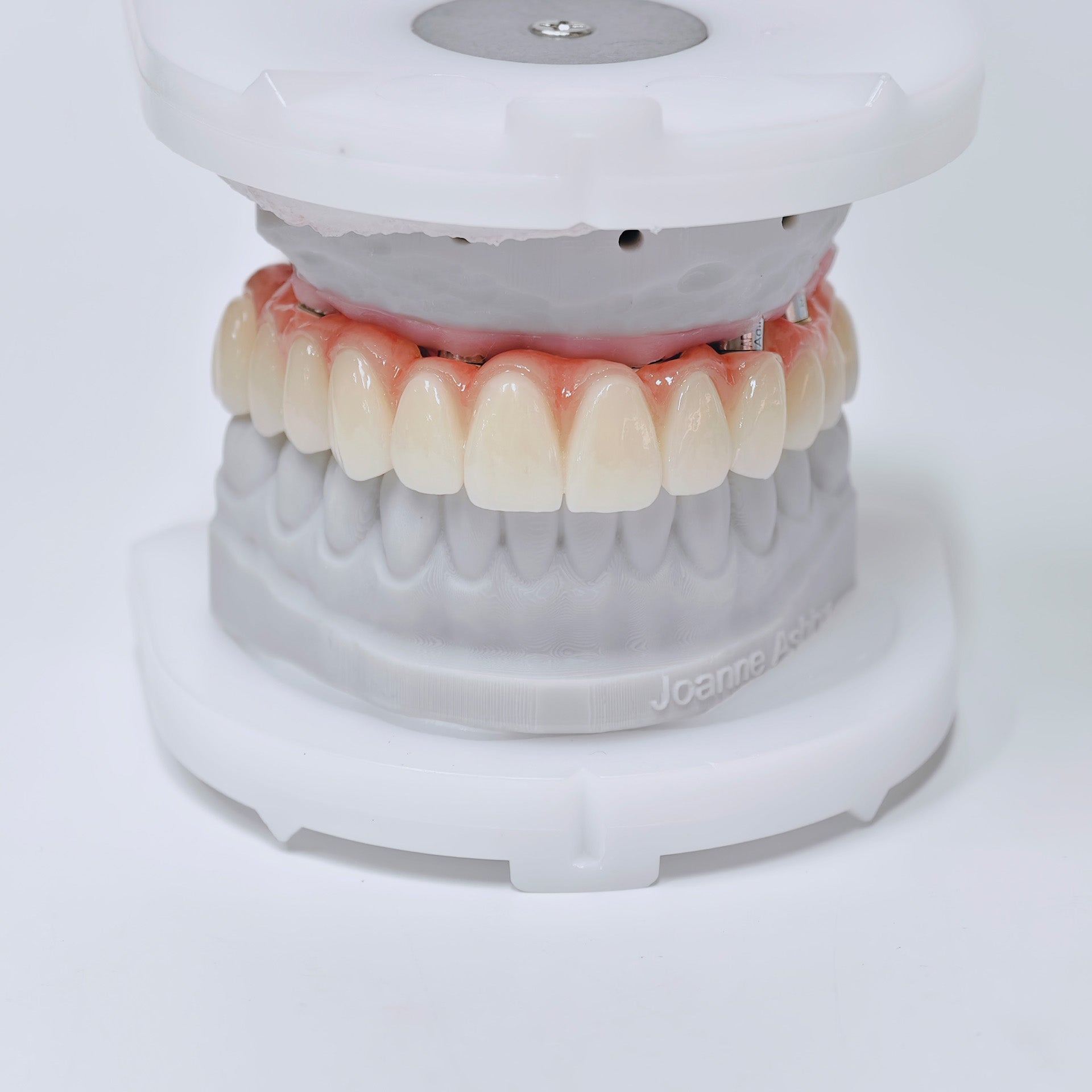 Ti-Bar Titanium Nitride Metal Frame With Zirconia Bridge For Full Arch Restoration