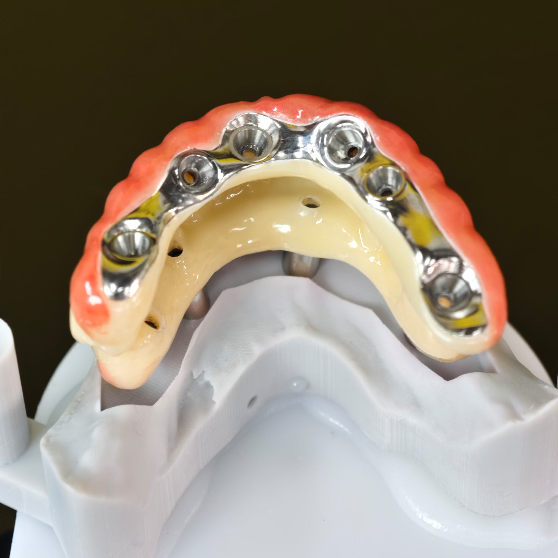 Ti-Bar Titanium Nitride Metal Frame With Zirconia Bridge For Full Arch Restoration