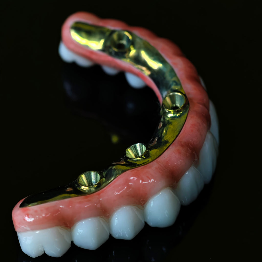 Ti-Bar Titanium Nitride Metal Frame With Zirconia Bridge For Full Arch Restoration