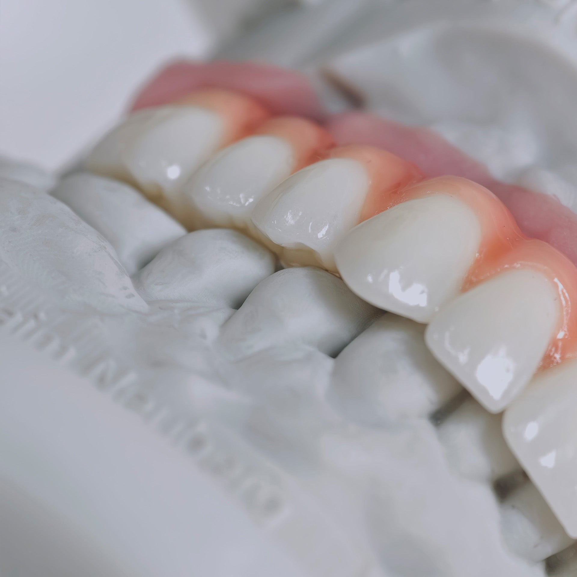 Zirconia-Enamel Hybrid Malo Bridge Aesthetic